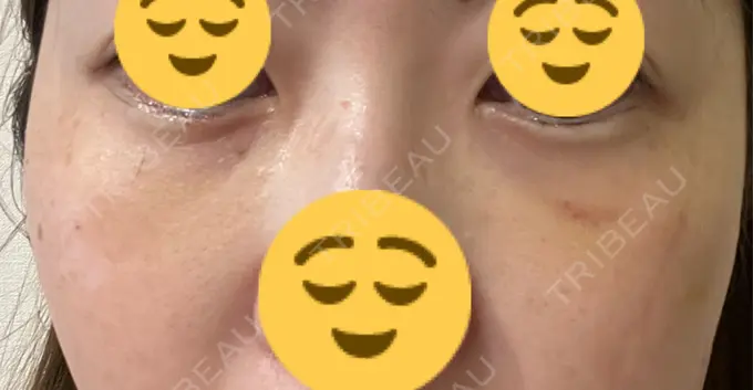 下まぶたたるみ取り / 脂肪注入（目の下） プラストクリニック DAY 8 メイン用