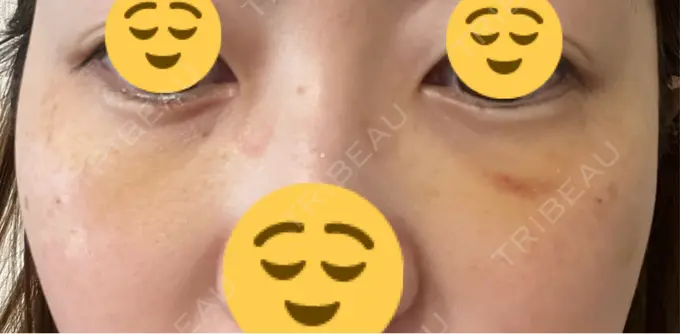 下まぶたたるみ取り / 脂肪注入（目の下） プラストクリニック DAY 6 メイン用