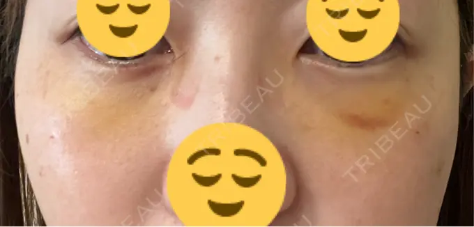 下まぶたたるみ取り / 脂肪注入（目の下） プラストクリニック DAY 4 メイン用