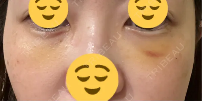 下まぶたたるみ取り / 脂肪注入（目の下） プラストクリニック DAY 5 メイン用