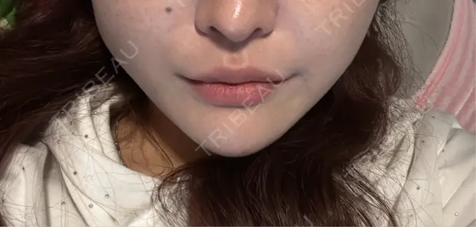 二重埋没 / ボトックス（あご） / ヒアルロン酸注入（あご） / ボトックス（エラ・小顔） アリエル美容クリニック 水戸院 DAY 5 メイン用