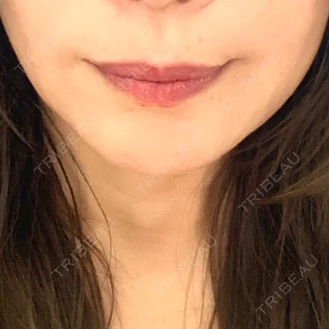 糸リフト / 肌ヒアルロン酸注入（たるみ・シワ改善） アリエル美容クリニック 横浜院 DAY 23 メイン用