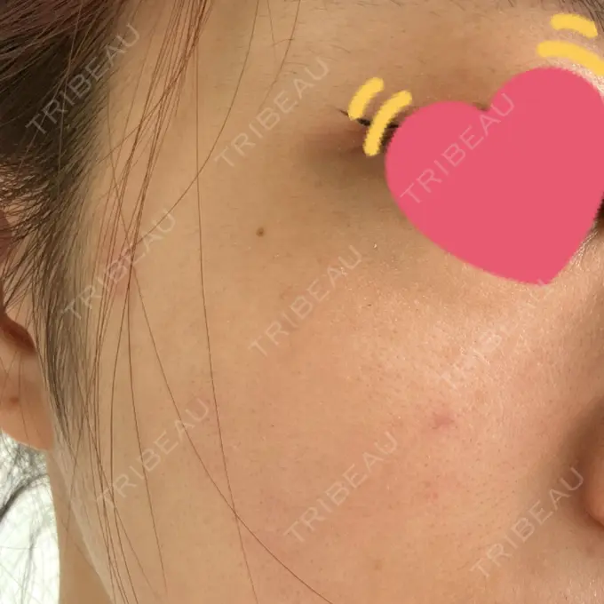 エレクトロポレーション / レーザートーニング（美白・肝斑） 新宿美容外科クリニック 新宿院 DAY 4 メイン用