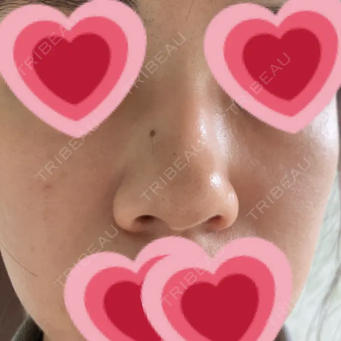 エレクトロポレーション / レーザートーニング（美白・肝斑） 新宿美容外科クリニック 新宿院 DAY 4 メイン用