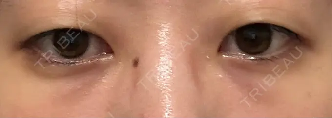 クマ治療 / 下まぶたたるみ取り / 下まぶたの脂肪取り / その他（目元） ROOTS Clinic AFTER メイン用