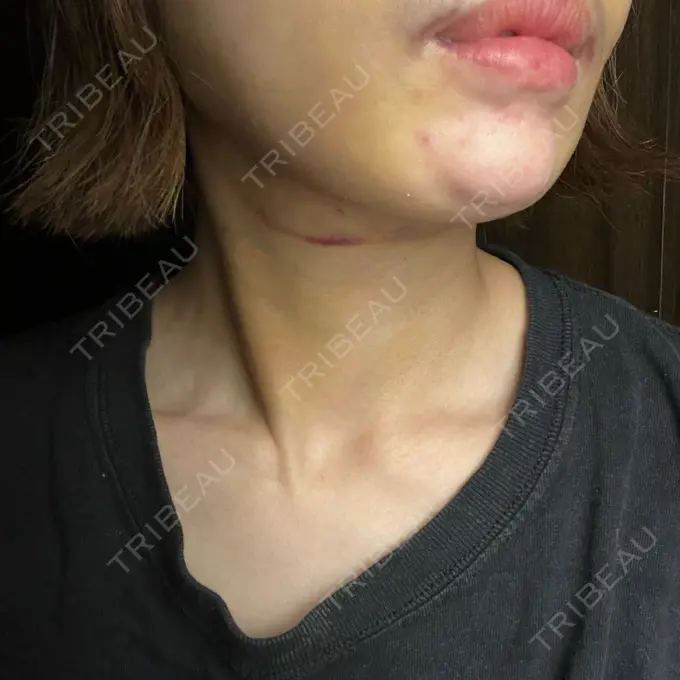 糸リフト / 脂肪吸引（顔） / ジョールファット除去 アリエル美容クリニック 横浜院 DAY 2 メイン用