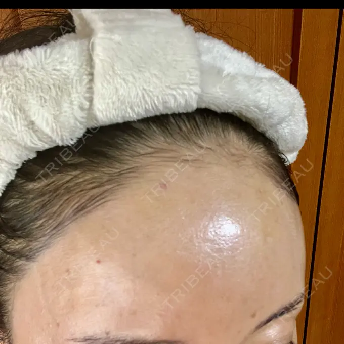 ヒアルロン酸注入（額） DMTC CLINIC 渋谷院 AFTER メイン用