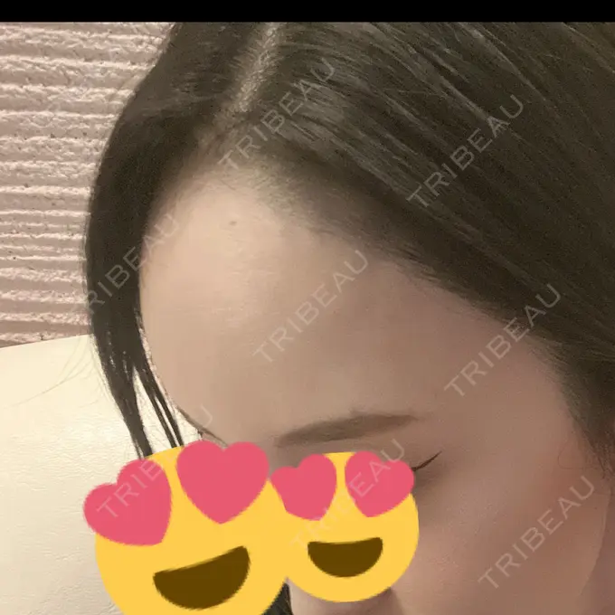 ヒアルロン酸注入（額） DMTC CLINIC 渋谷院 DAY 1 メイン用