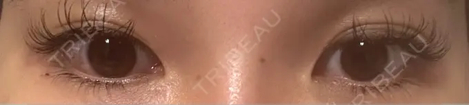 ヒアルロン酸注入（涙袋） フィラークリニック 名古屋栄院 DAY 0 メイン用