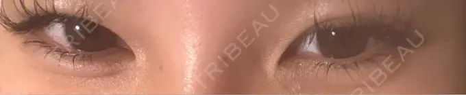 ヒアルロン酸注入（涙袋） フィラークリニック 名古屋栄院 DAY 0 メイン用