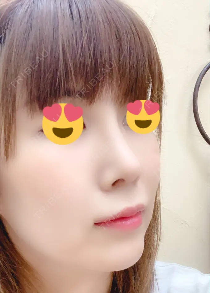 隆鼻術 / 鼻尖形成（切開） / 鼻中隔延長（切開） / 脂肪吸引（顔） / 軟骨移植 / プロテーゼ除去 / ヒアルロン酸注入（唇） ジュエリー美容外科 AFTER メイン用