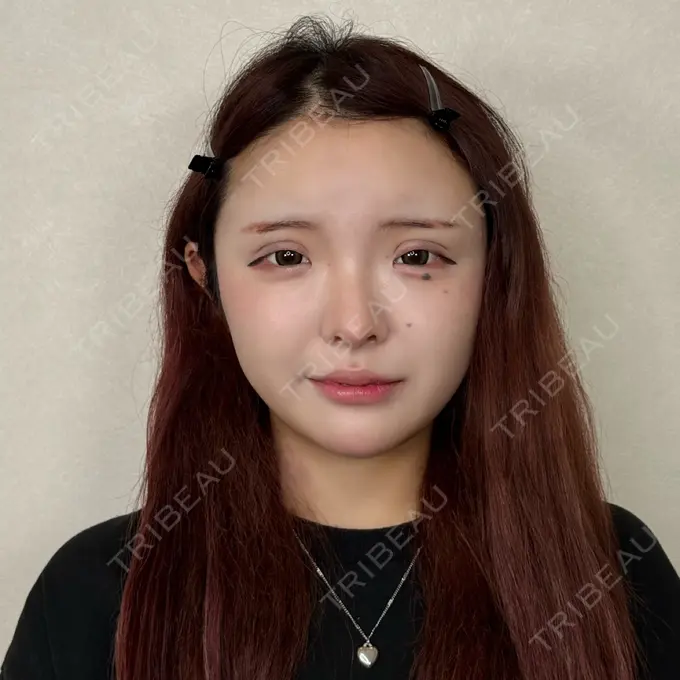 二重埋没 / ボトックス（あご） / ヒアルロン酸注入（あご） / ボトックス（エラ・小顔） アリエル美容クリニック 水戸院 DAY 7 メイン用