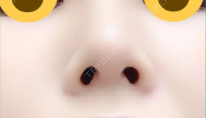 隆鼻術 / 鼻尖形成（切開） / 鼻中隔延長（切開） / 脂肪吸引（顔） / 軟骨移植 / プロテーゼ除去 / ヒアルロン酸注入（唇） ジュエリー美容外科 DAY 65 メイン用