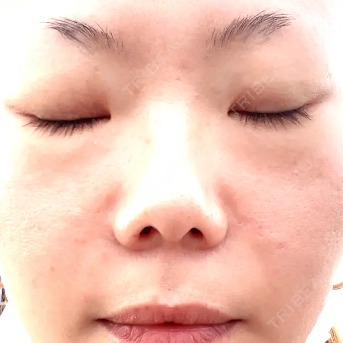 ボトックス（眉間） / その他（輪郭） TCB東京中央美容外科 福岡天神院 AFTER メイン用