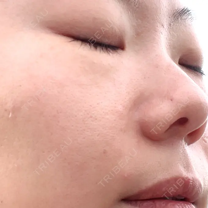 ボトックス（眉間） / その他（輪郭） TCB東京中央美容外科 福岡天神院 DAY 6 メイン用