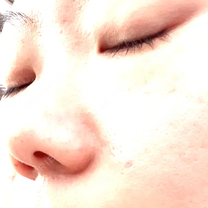 ボトックス（眉間） / その他（輪郭） TCB東京中央美容外科 福岡天神院 DAY 6 メイン用