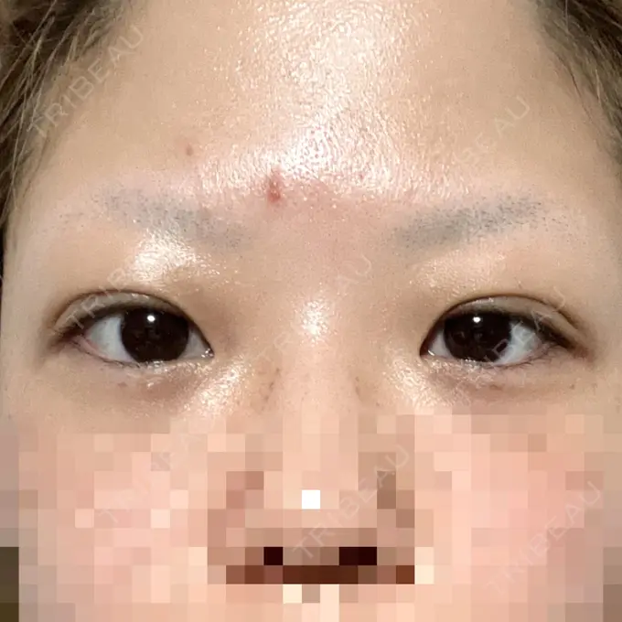 二重埋没 アリエル美容クリニック 横浜院 DAY 3 メイン用