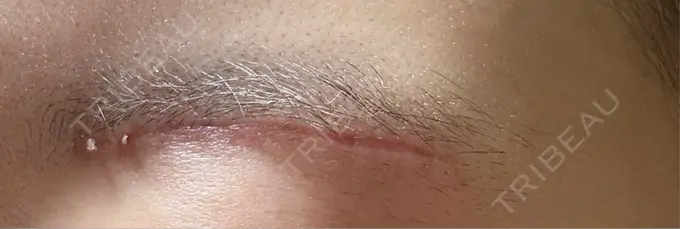 下まぶたの脂肪取り / 眉下切開 東京中央クリニック DAY 48 メイン用