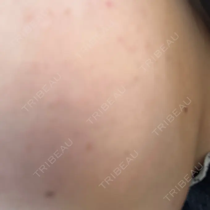 ボトックス（エラ・小顔） 共立美容外科 名古屋院 DAY 1 メイン用