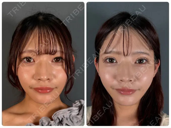 二重埋没 / 糸リフト 神戸美容外科 ネビュラクリニック AFTER メイン用