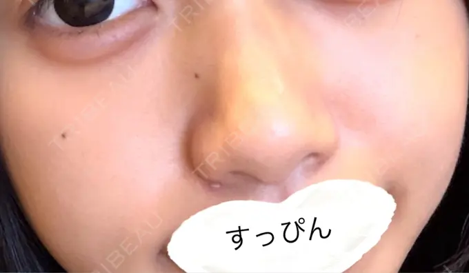 白玉点滴・注射 / 毛穴洗浄（ハイドラフェイシャルなど） ルラ美容クリニック 大阪本院 DAY 0 メイン用