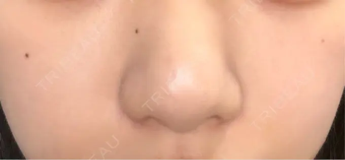 白玉点滴・注射 / 毛穴洗浄（ハイドラフェイシャルなど） ルラ美容クリニック 大阪本院 AFTER メイン用