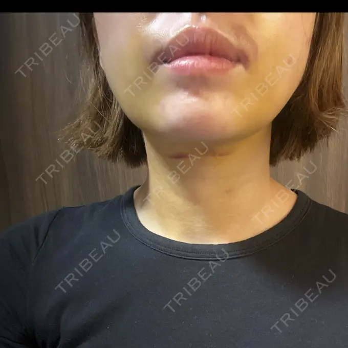 糸リフト / 脂肪吸引（顔） / ジョールファット除去 アリエル美容クリニック 横浜院 DAY 3 メイン用