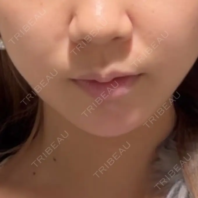 ボトックス（あご） / ヒアルロン酸注入（あご） BITO BEAUTY CLINIC AFTER メイン用