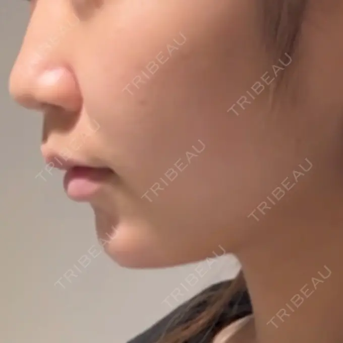 ボトックス（あご） / ヒアルロン酸注入（あご） BITO BEAUTY CLINIC DAY 0 メイン用