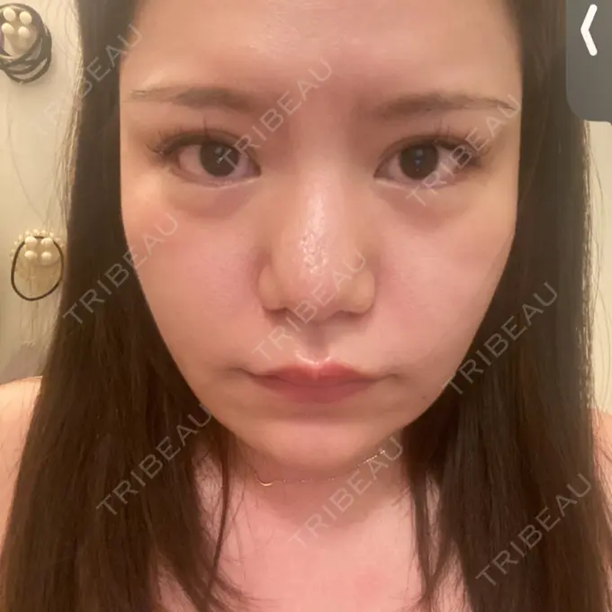 脂肪溶解注射（顔） SK新宿歌舞伎町美容外科・歯科 DAY 1 メイン用