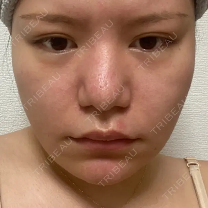 脂肪溶解注射（顔） SK新宿歌舞伎町美容外科・歯科 DAY 2 メイン用