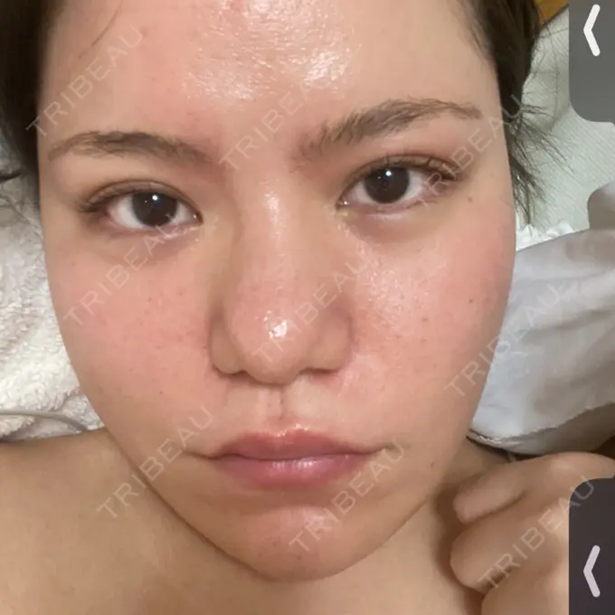 脂肪溶解注射（顔） SK新宿歌舞伎町美容外科・歯科 DAY 10 メイン用