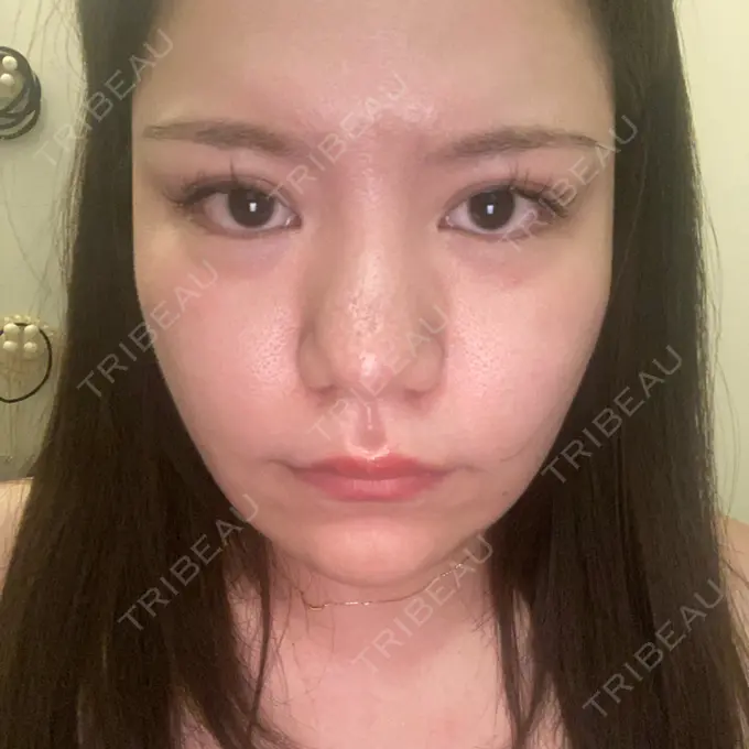 脂肪溶解注射（顔） SK新宿歌舞伎町美容外科・歯科 DAY 22 メイン用