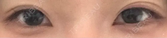 上まぶたたるみ取り / 目元修正 BIANCA銀座 DAY 7 メイン用