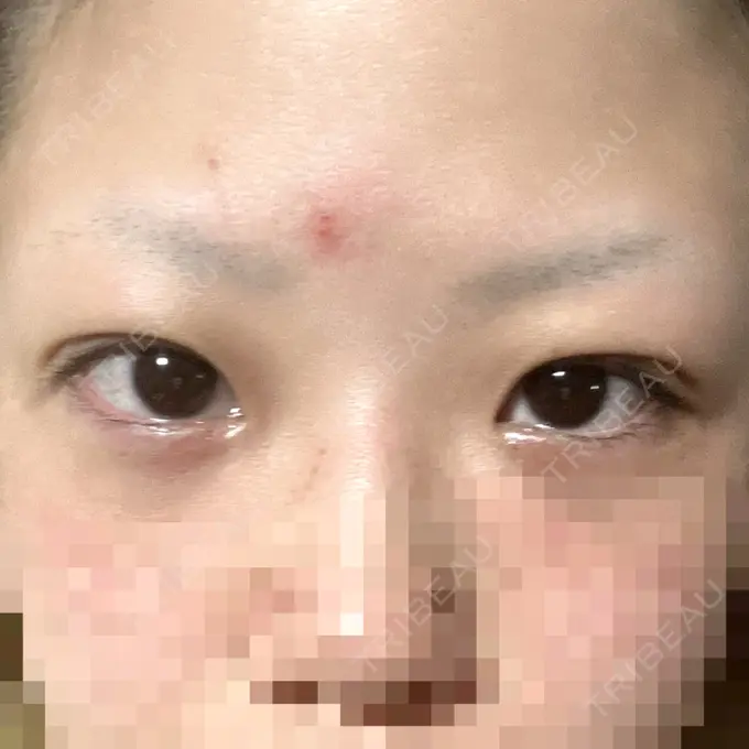 二重埋没 アリエル美容クリニック 横浜院 DAY 4 メイン用