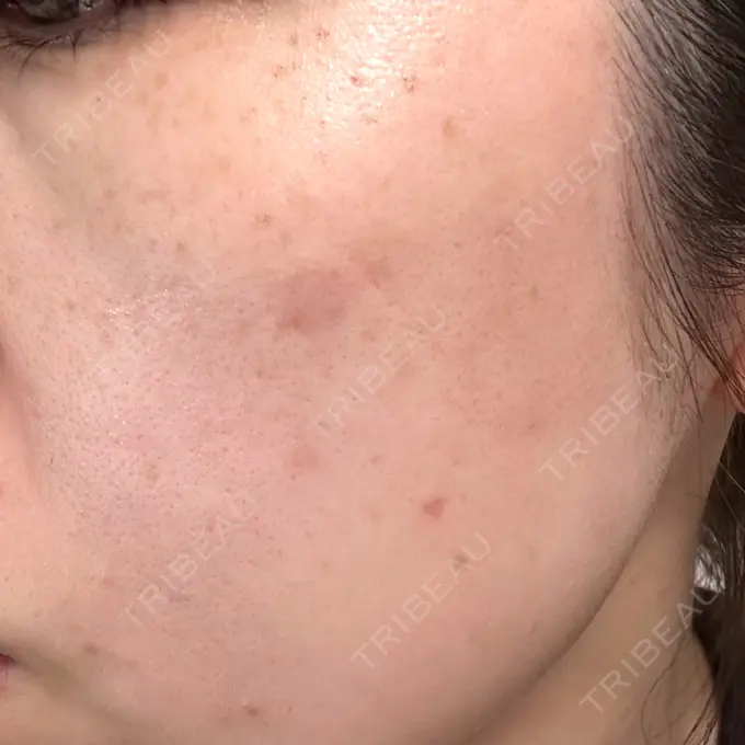 イオン導入 / ピーリング（ハリ・ツヤ） / ルメッカ ルラ美容クリニック 福岡本院 AFTER メイン用