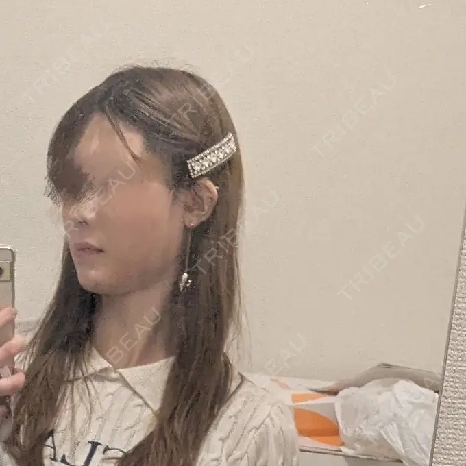 ヒアルロン酸注入（あご） TCB東京中央美容外科 青森院 DAY 1 メイン用