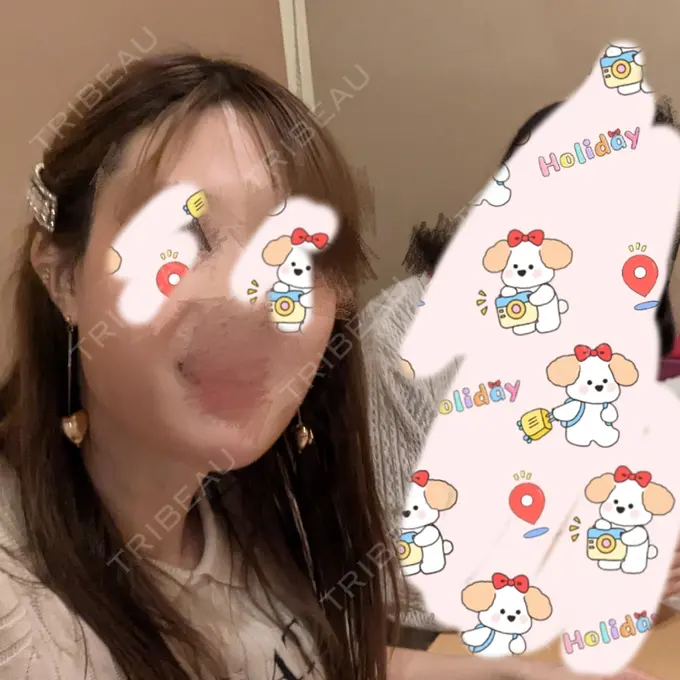 ヒアルロン酸注入（あご） TCB東京中央美容外科 青森院 DAY 2 メイン用