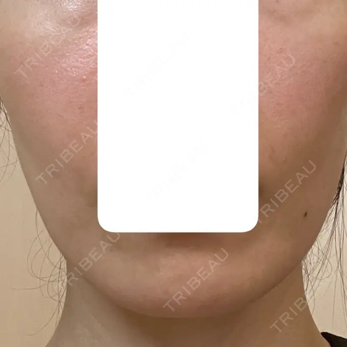 肌育注射（ジュベルックなど） 城本クリニック 長崎院 AFTER メイン用