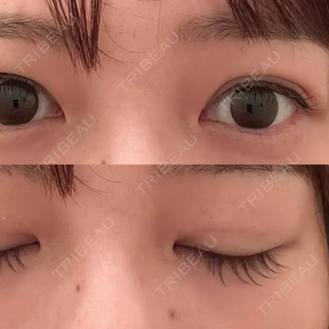 二重埋没 / 糸リフト アリエル美容クリニック 横浜院 DAY 4 メイン用