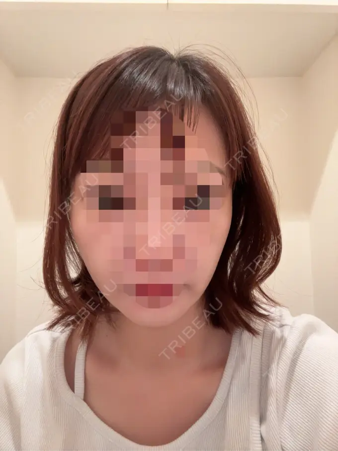 二重埋没 / 糸リフト アリエル美容クリニック 横浜院 DAY 4 メイン用