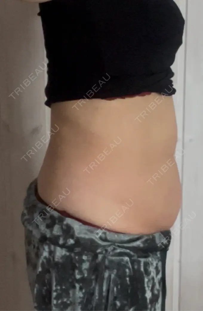 医療痩身（お腹） 湘南美容クリニック 名古屋駅本院 AFTER メイン用