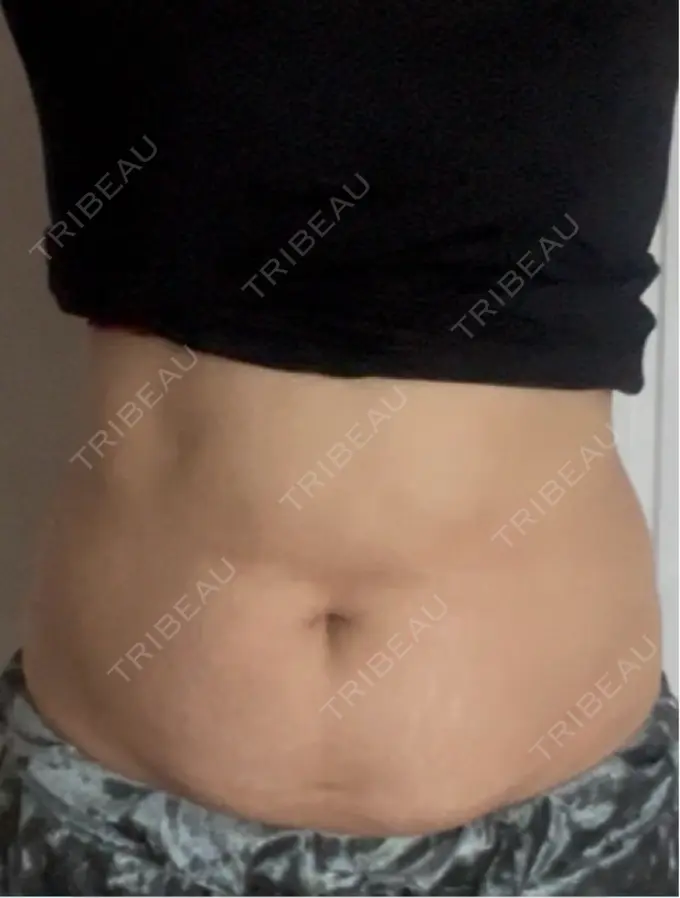 医療痩身（お腹） 湘南美容クリニック 名古屋駅本院 DAY 3 メイン用