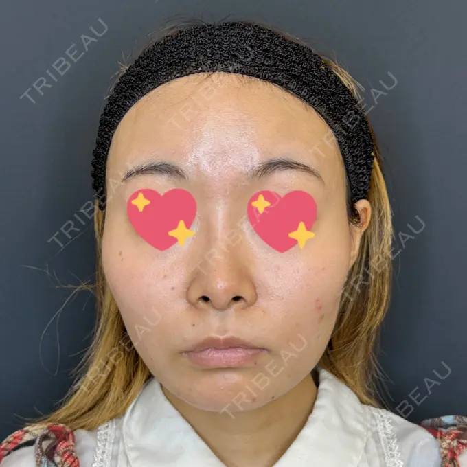 脂肪吸引（顔） ルラ美容クリニック 大宮院 / ルラスキンクリニック 大宮院 AFTER メイン用