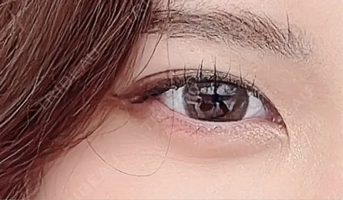 クマ治療 R Beauty CLINIC 銀座院 AFTER メイン用