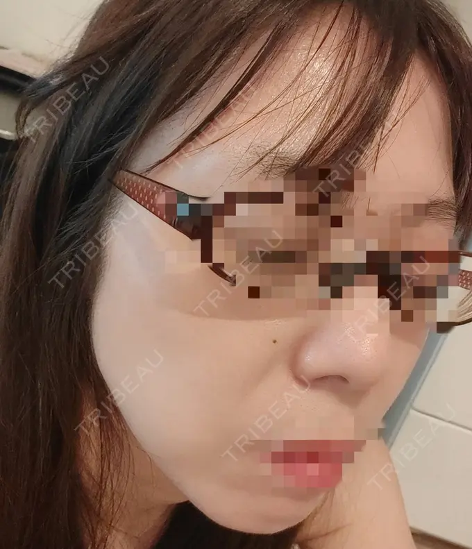 ピコスポット APスキンクリニック銀座 AFTER メイン用