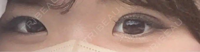 二重埋没 R Beauty CLINIC 銀座院 AFTER メイン用