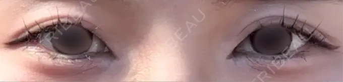 目頭切開 PRISM Beauty Clinic 町田院 DAY 16 メイン用