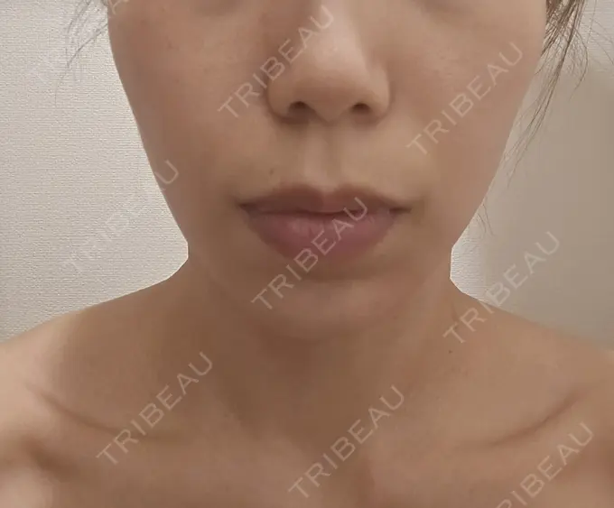 ハイフ（顔） 東京美容外科 福岡院 DAY 18 メイン用