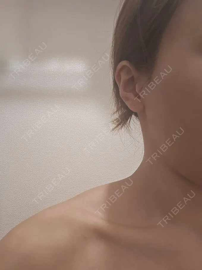 ボトックス（エラ・小顔） / ボトックス（肩） ヴァージンクリニック 福岡天神院 DAY 12 メイン用